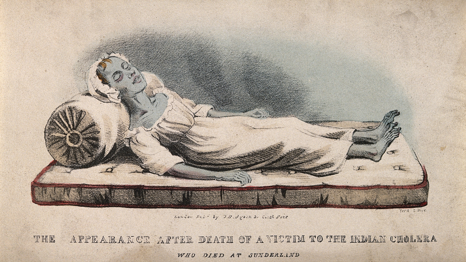 A dead victim of cholera at Sunderland in 1832
